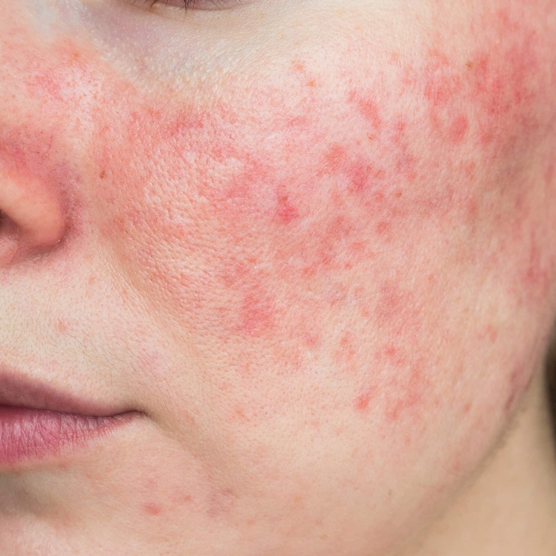 Woman Suffering From Rosacea On Her Face