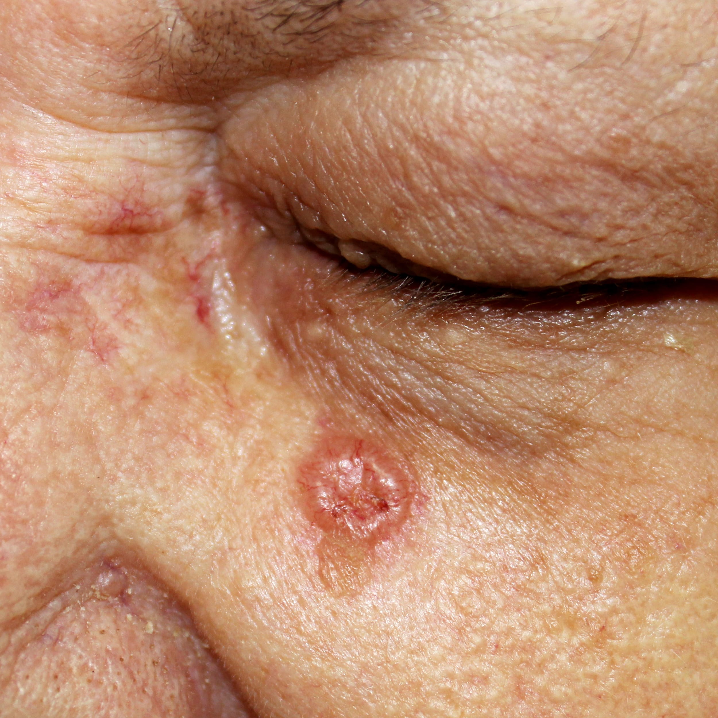 basal cell carcinoma