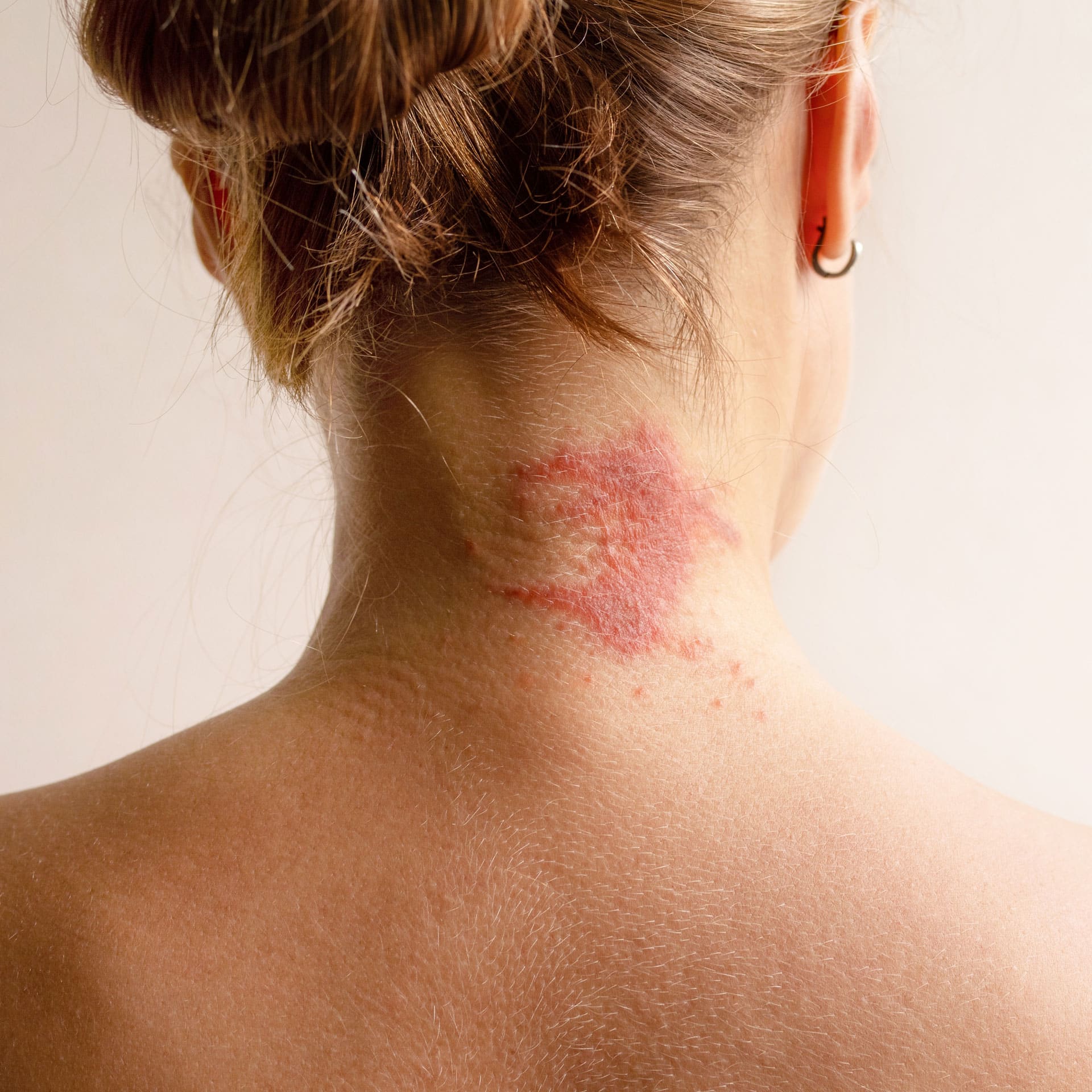 eczema