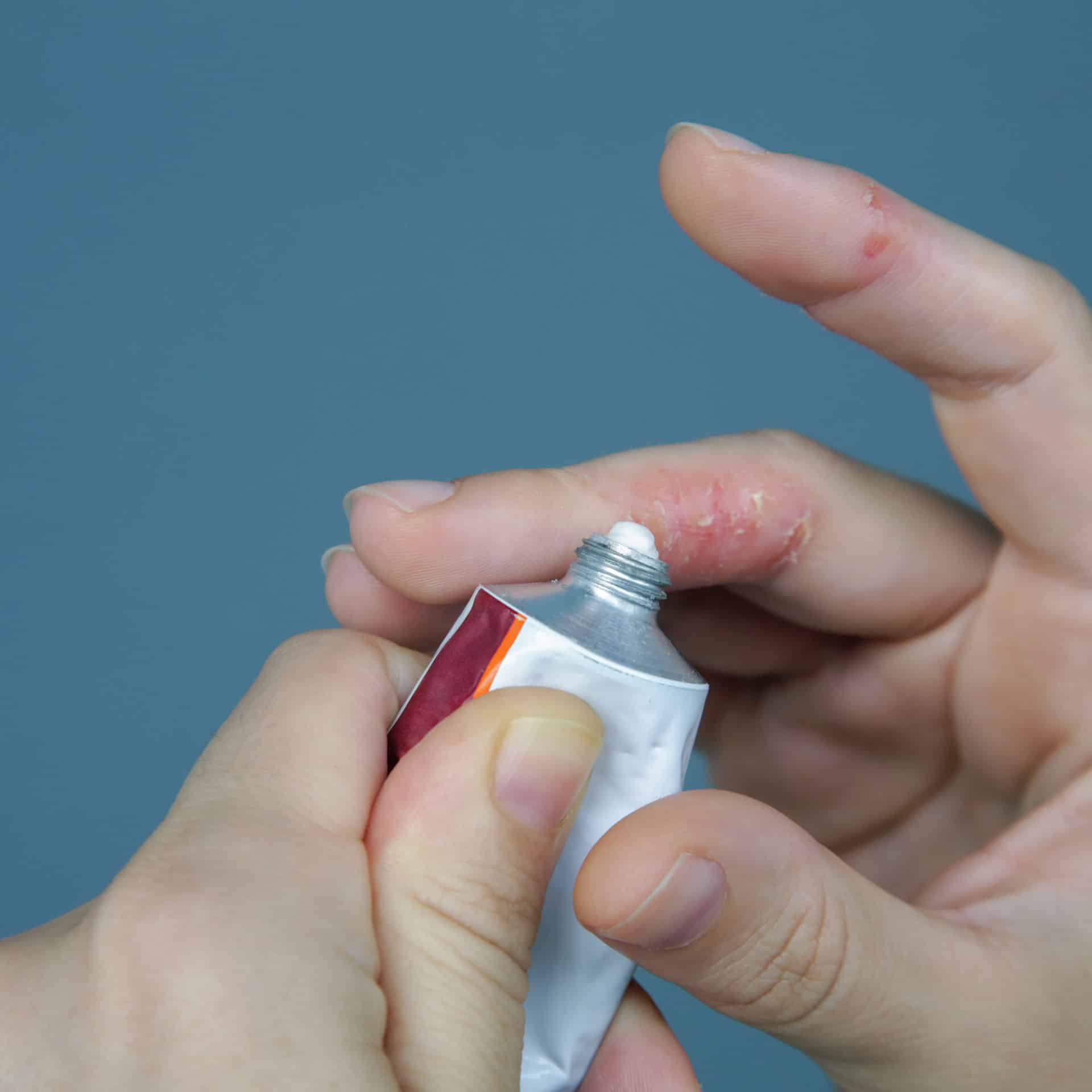 eczema treatment