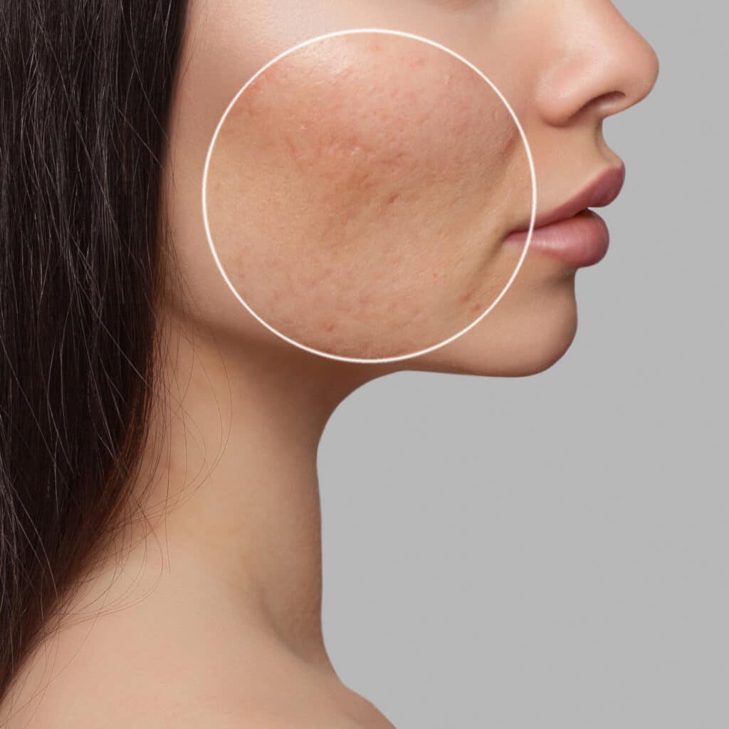 Facial Scars Treatment