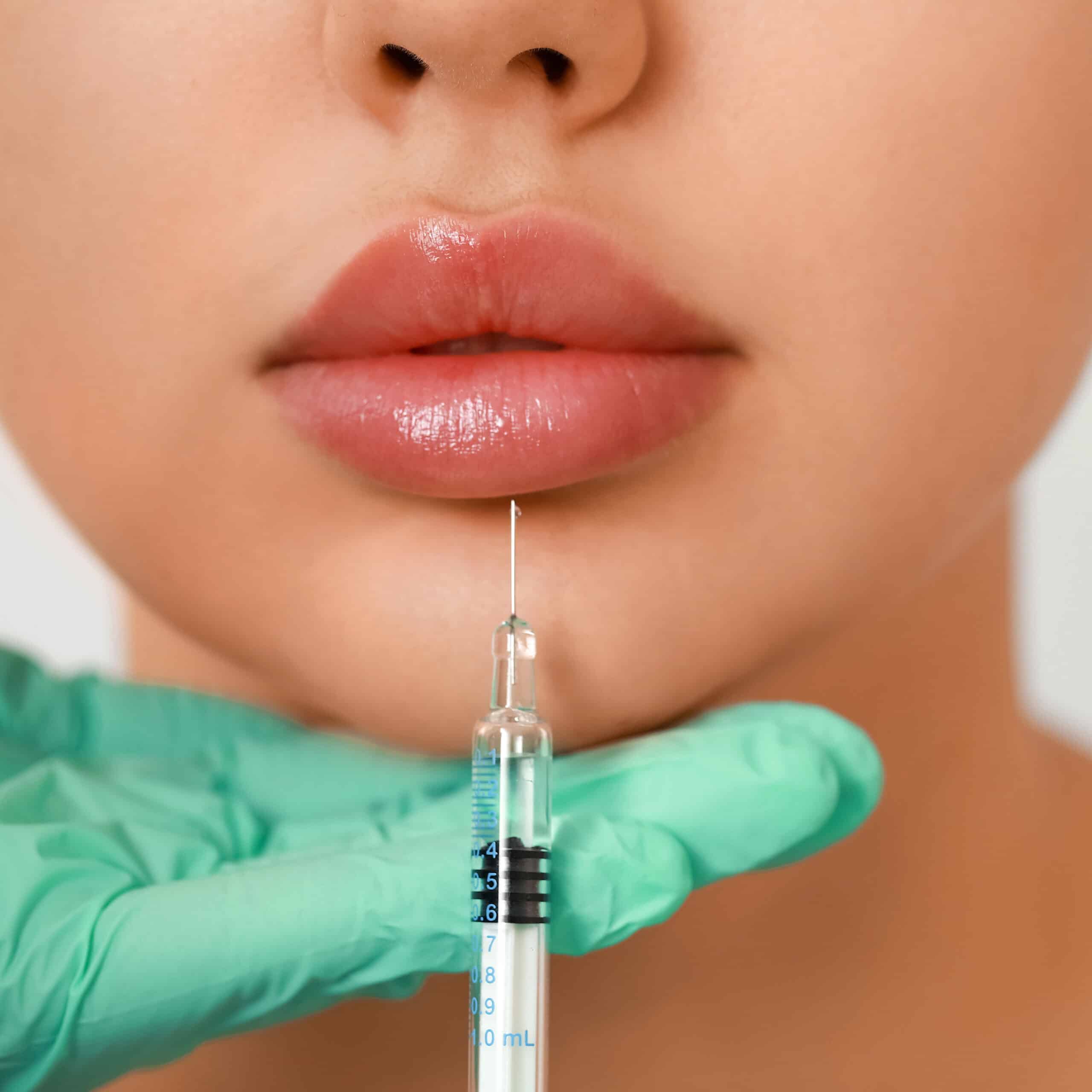 Juvaderm treatment of the face