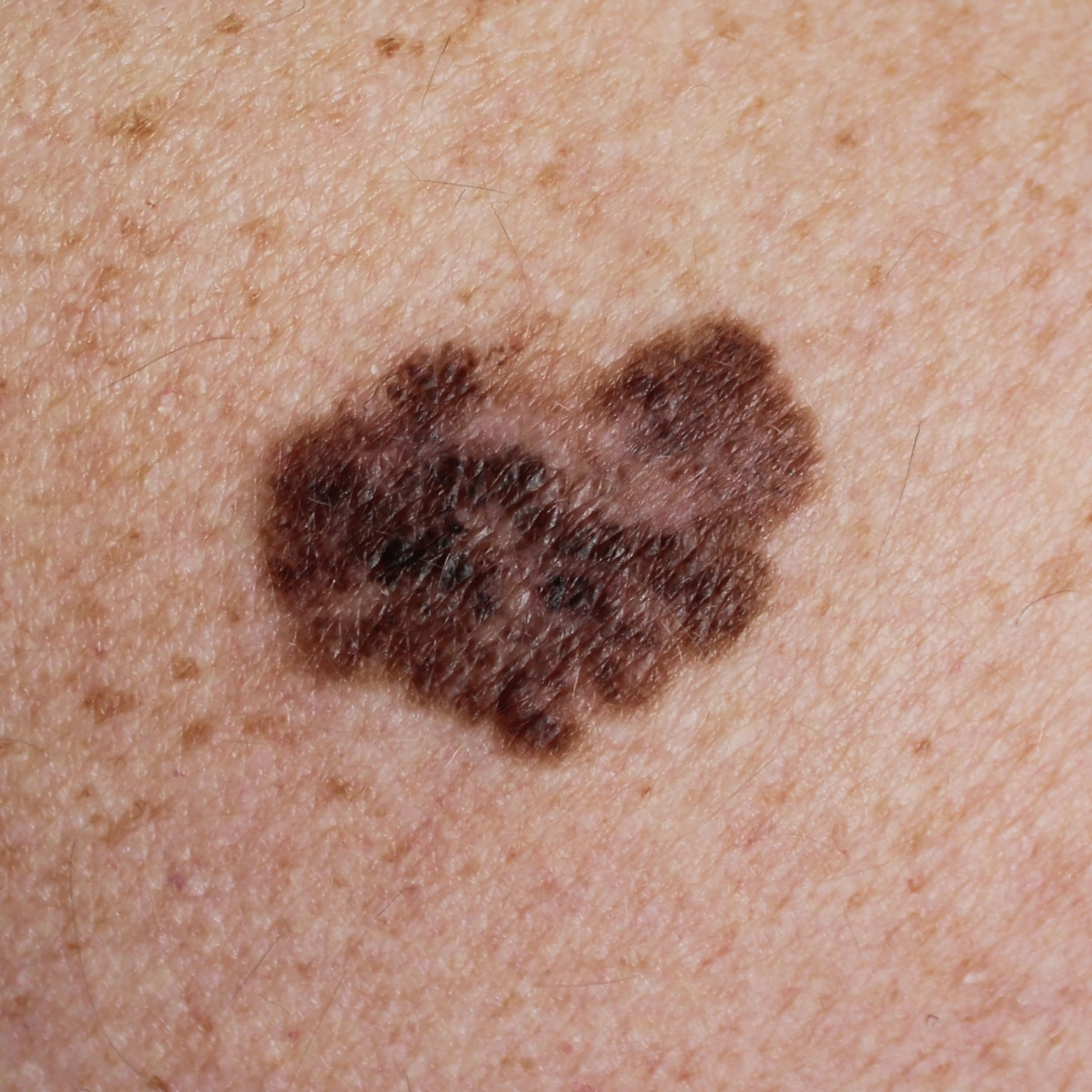 Melanoma - A Malignant Tumor Of The Skin