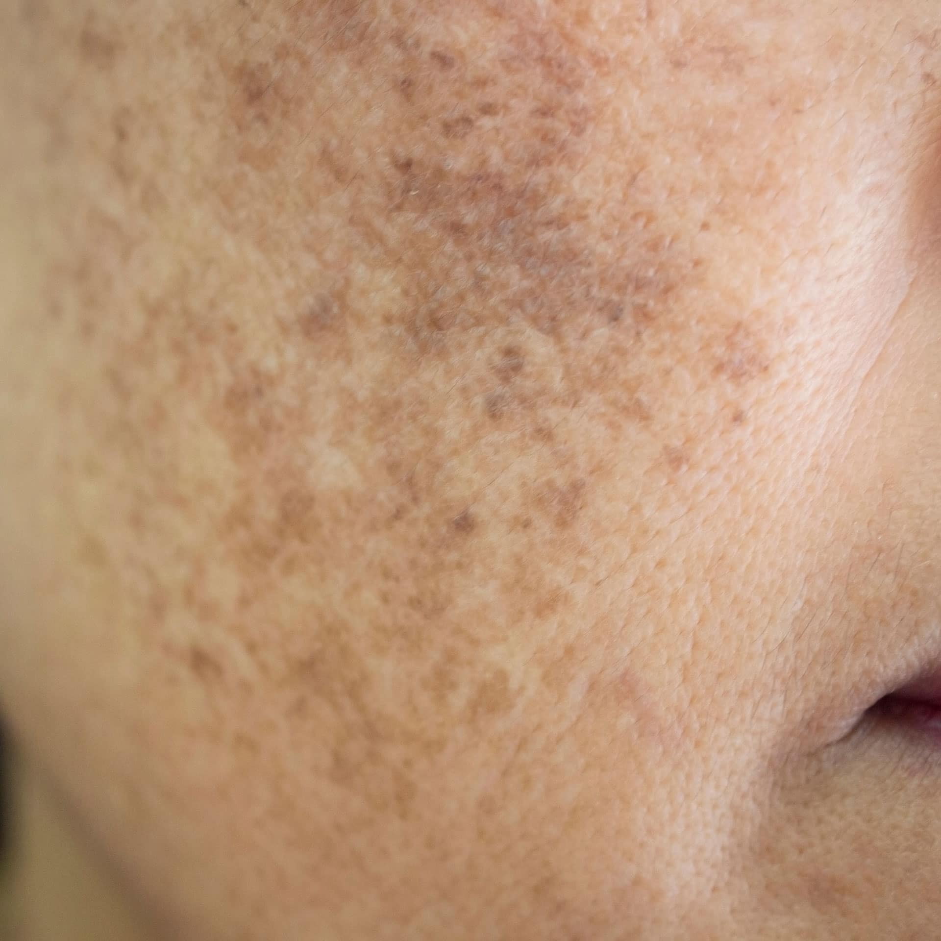 melasma