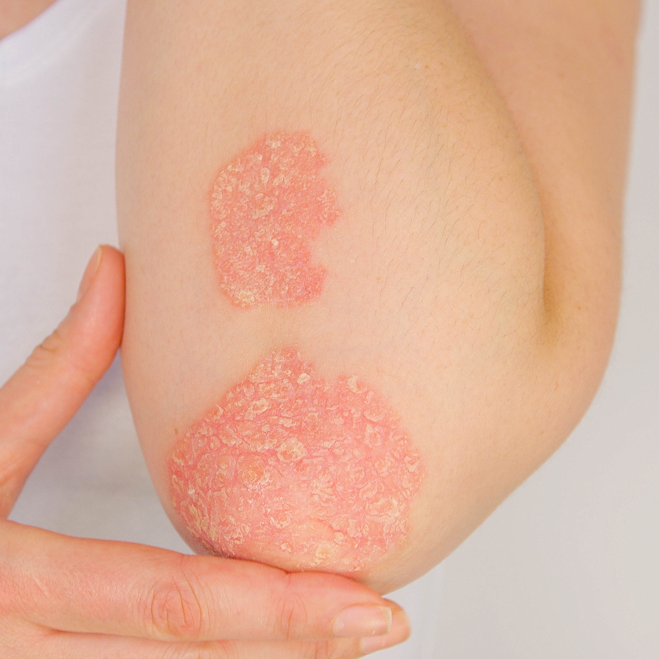 Woman with Psoriasis on her arm