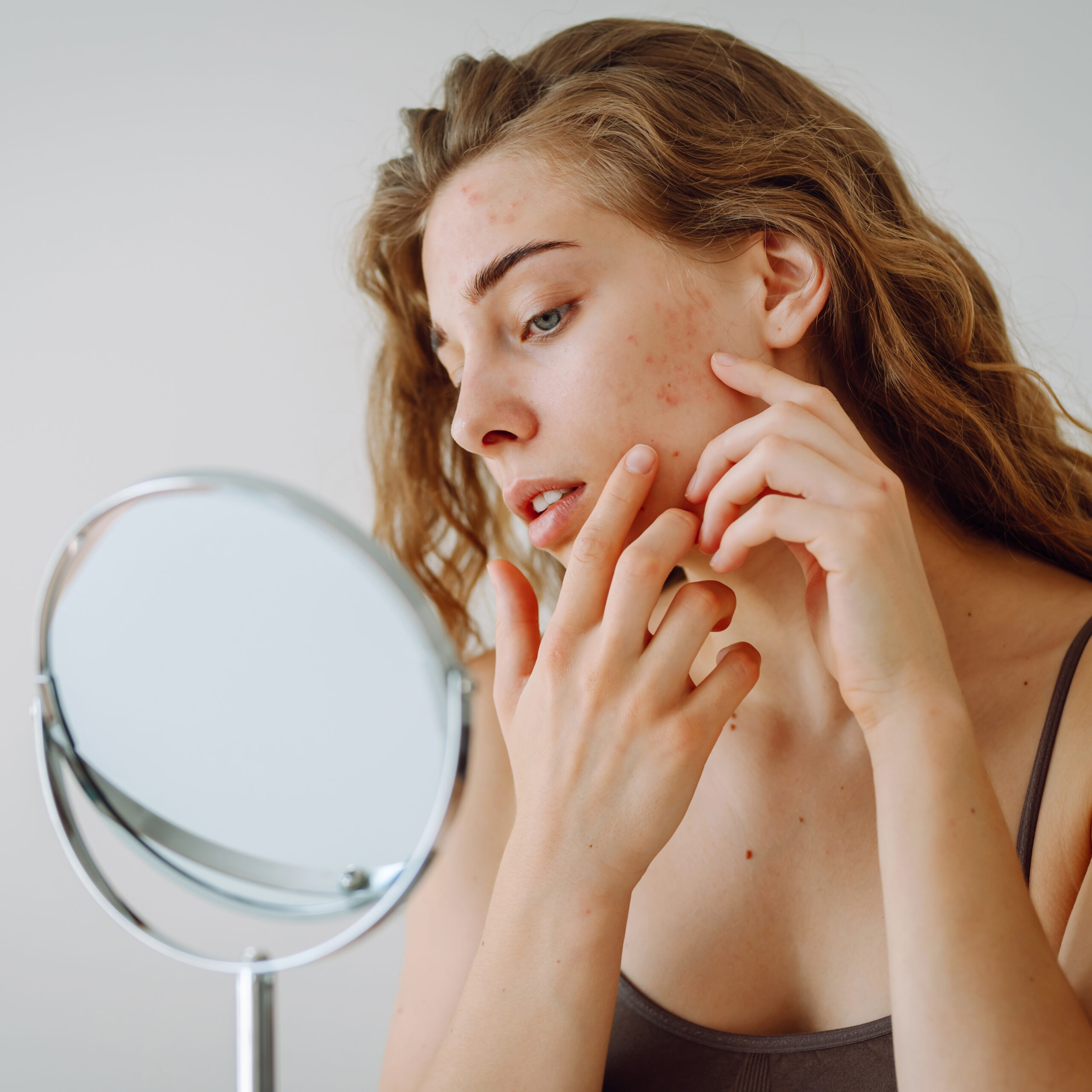 Woman with rosacea
