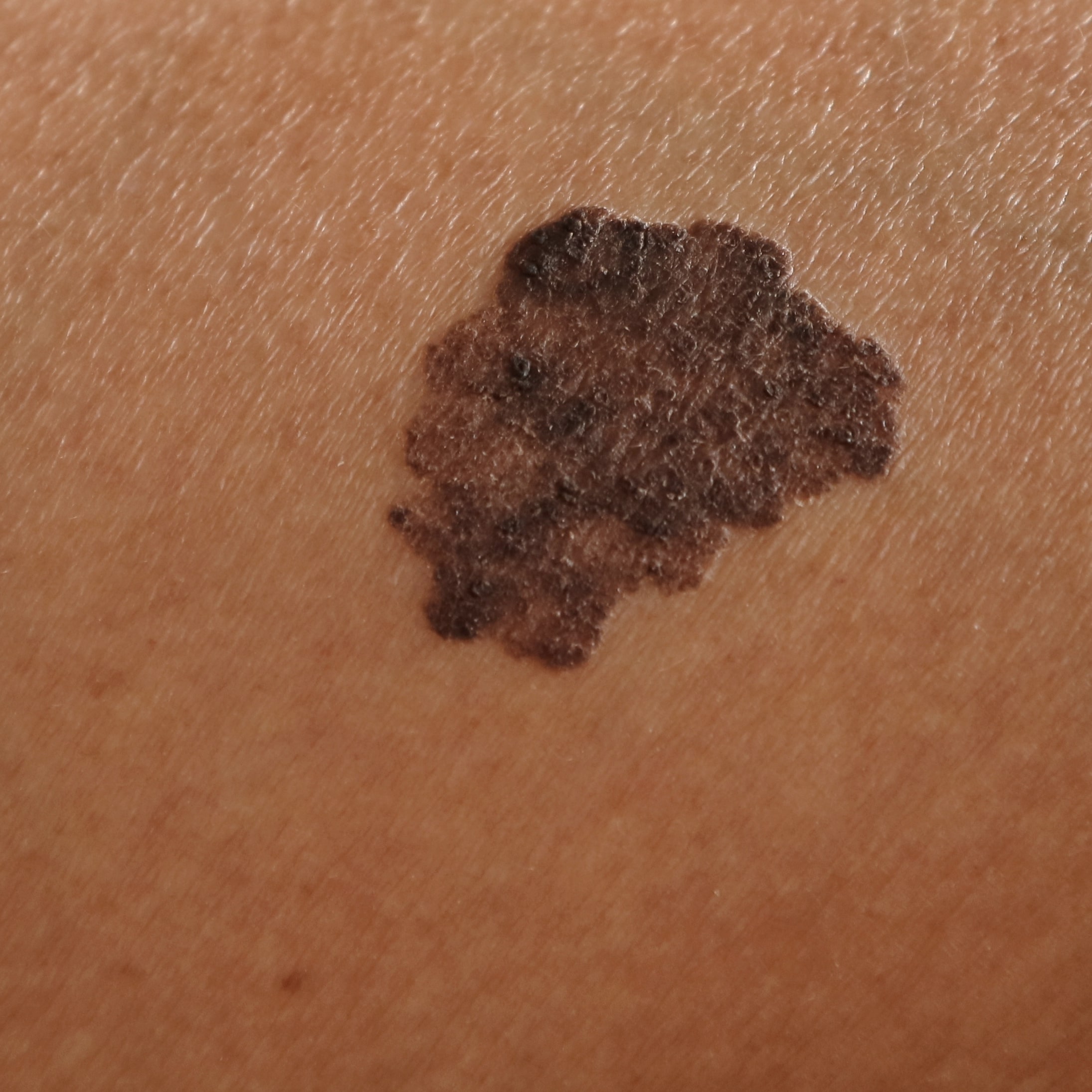 Melanoma -A Malignant Tumor Of The Skin