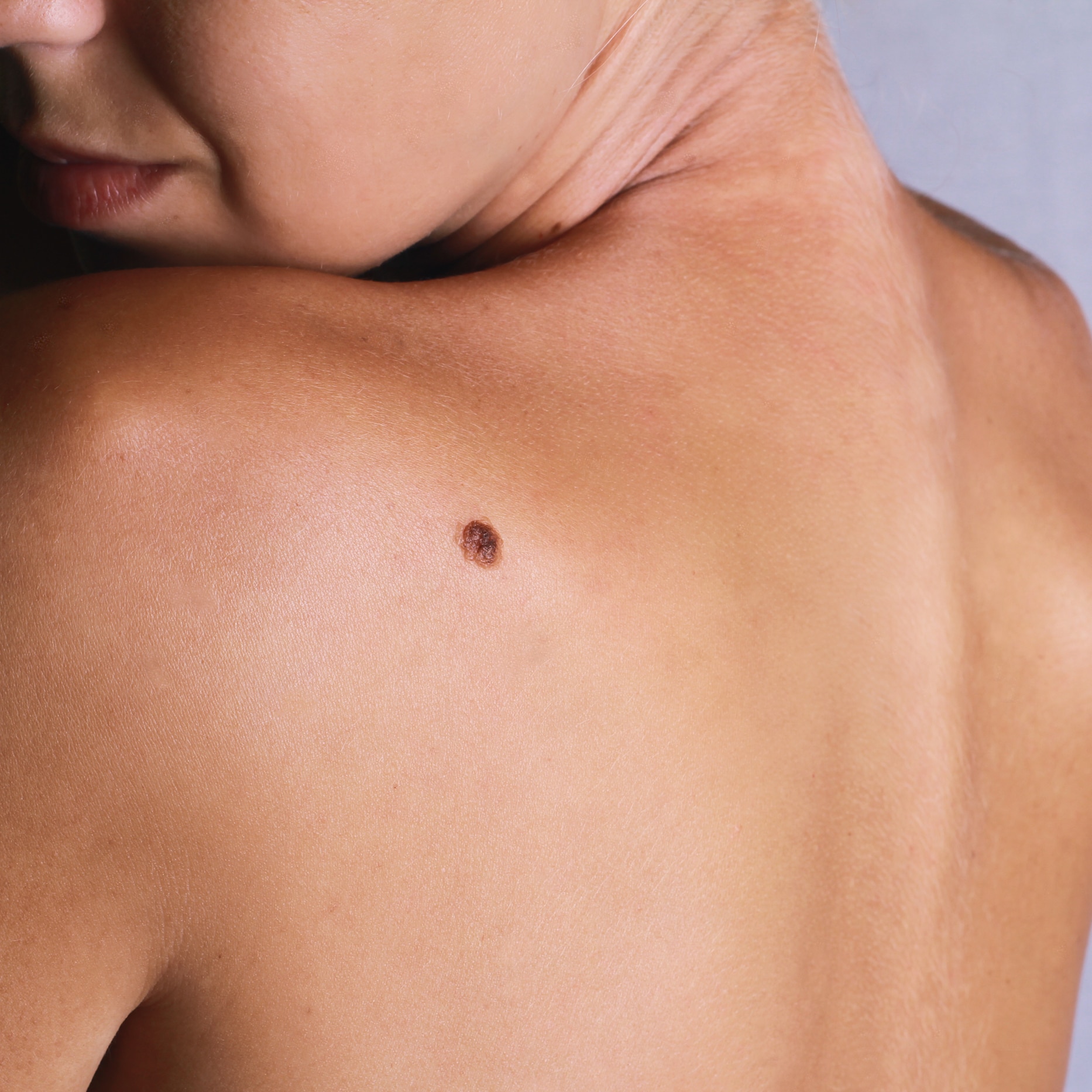 skin cancer -spot on a woman's back