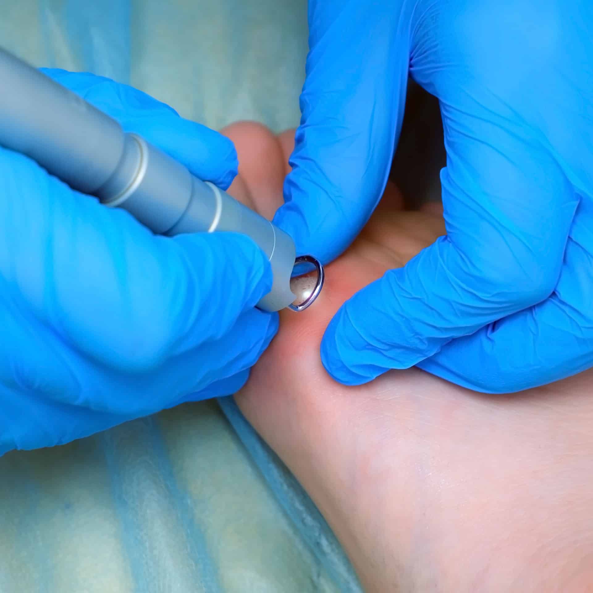 wart treatment