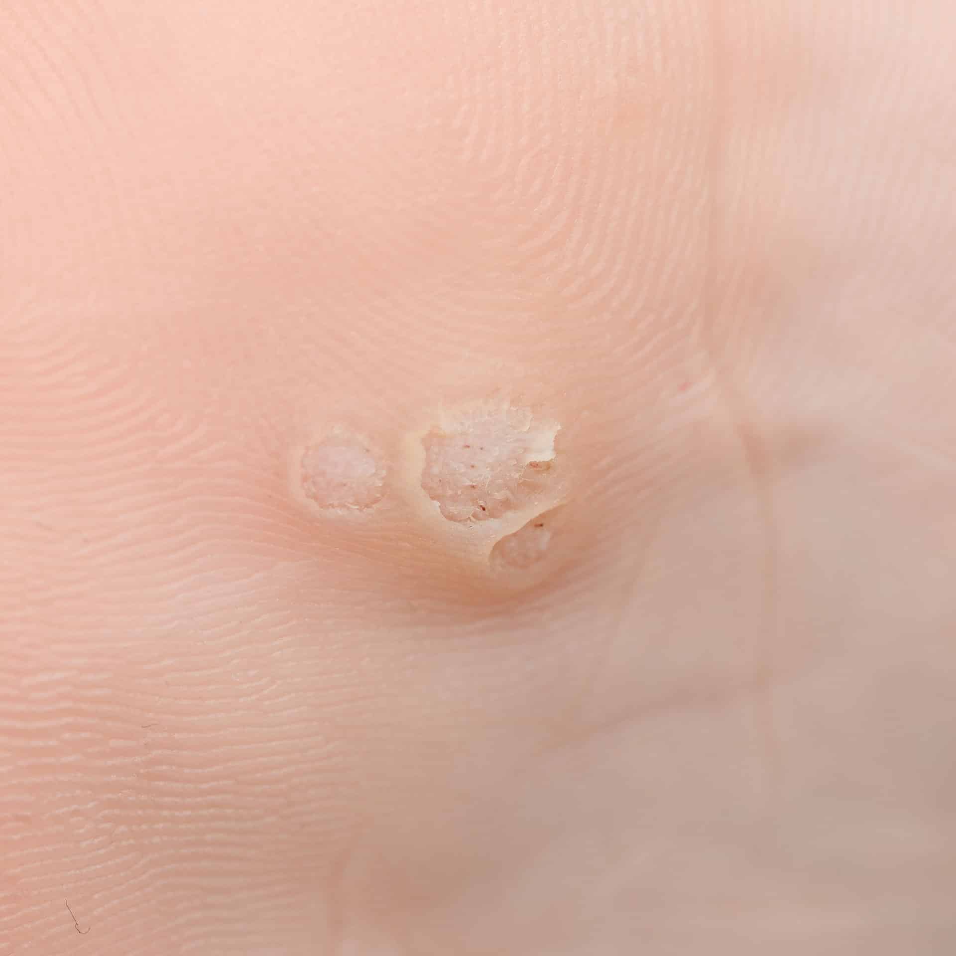 warts